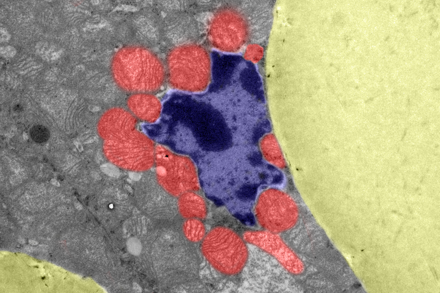 The image shows the cross section mutant brown adipose tissue section with enlarged lipid droplets (yellow) and nucleus (blue) being impinged by multiple mitochondria.